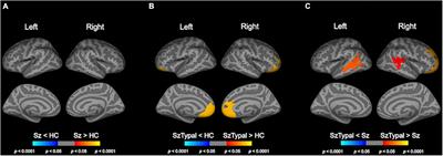 Longitudinal Changes in Brain Gyrification in Schizophrenia Spectrum Disorders